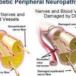 Adverse Reactions in Pooled Placebo-Controlled Trials in Postherpetic Neuralgia