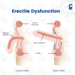 What is Erectile Dysfunction and Why I Get ED ?