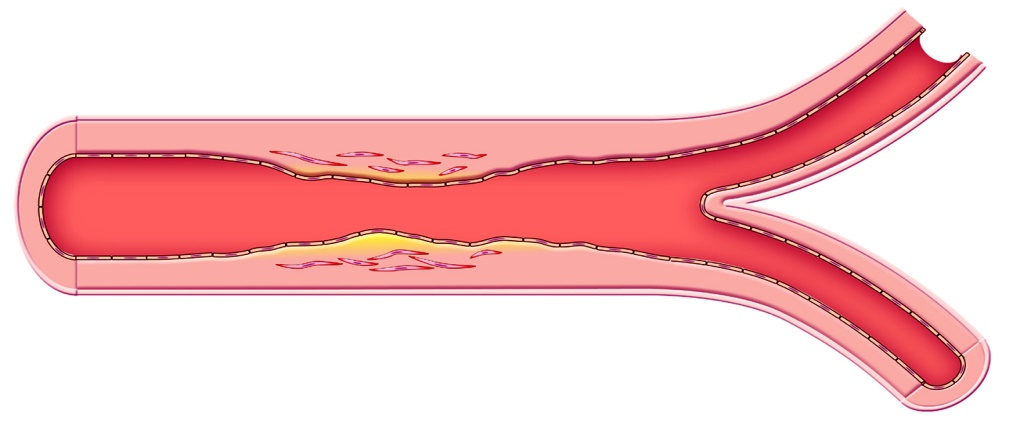 Atherosclerosis (narrowing) of an artery